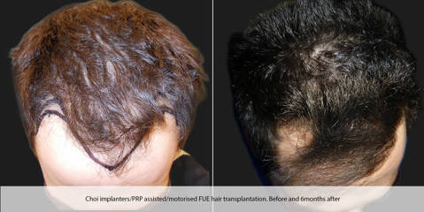 Hair Transplantation13