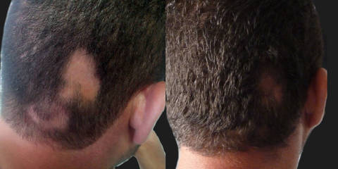Hair Transplantation11