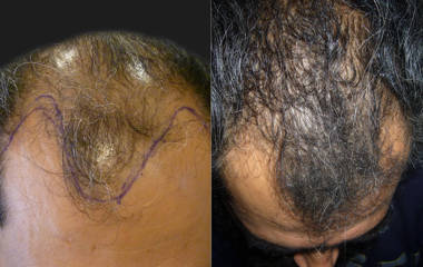 Hair Transplantation7