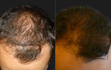 Hair Transplantation8