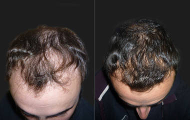 Hair Transplantation4
