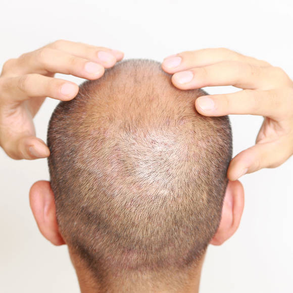 Hair Restoration Crete Liapakis 4