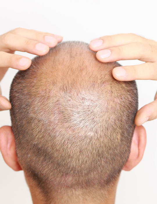 Hair Restoration Crete Liapakis 4