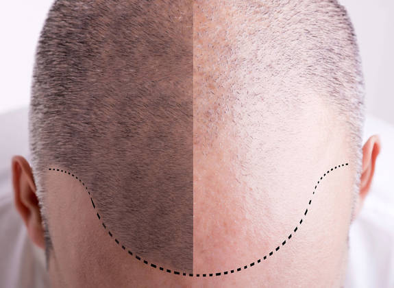 Hair Restoration Crete Liapakis 9
