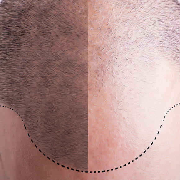 Hair Restoration Crete Liapakis 9