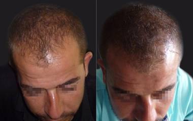Hair Transplantation10