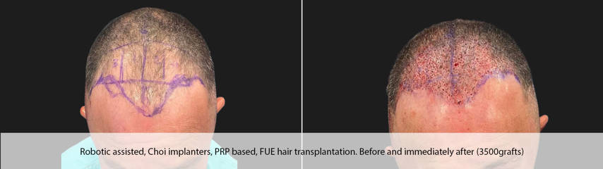 Hair Transplantation14