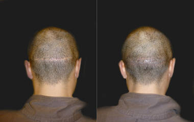 Hair Transplantation6