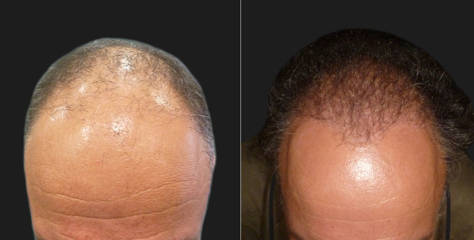 Hair Transplantation12