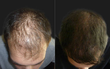 Hair Transplantation3