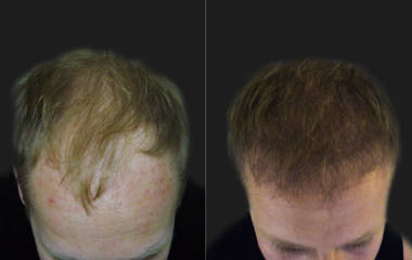 Hair Transplantation2