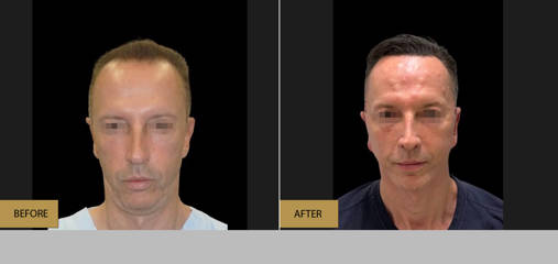Hair Restoration