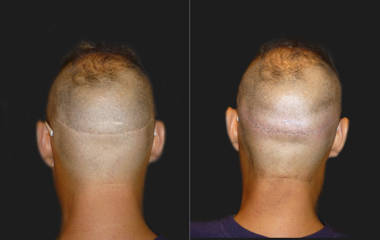 Hair Transplantation5