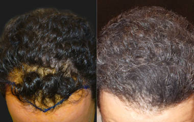 Hair Transplantation 2